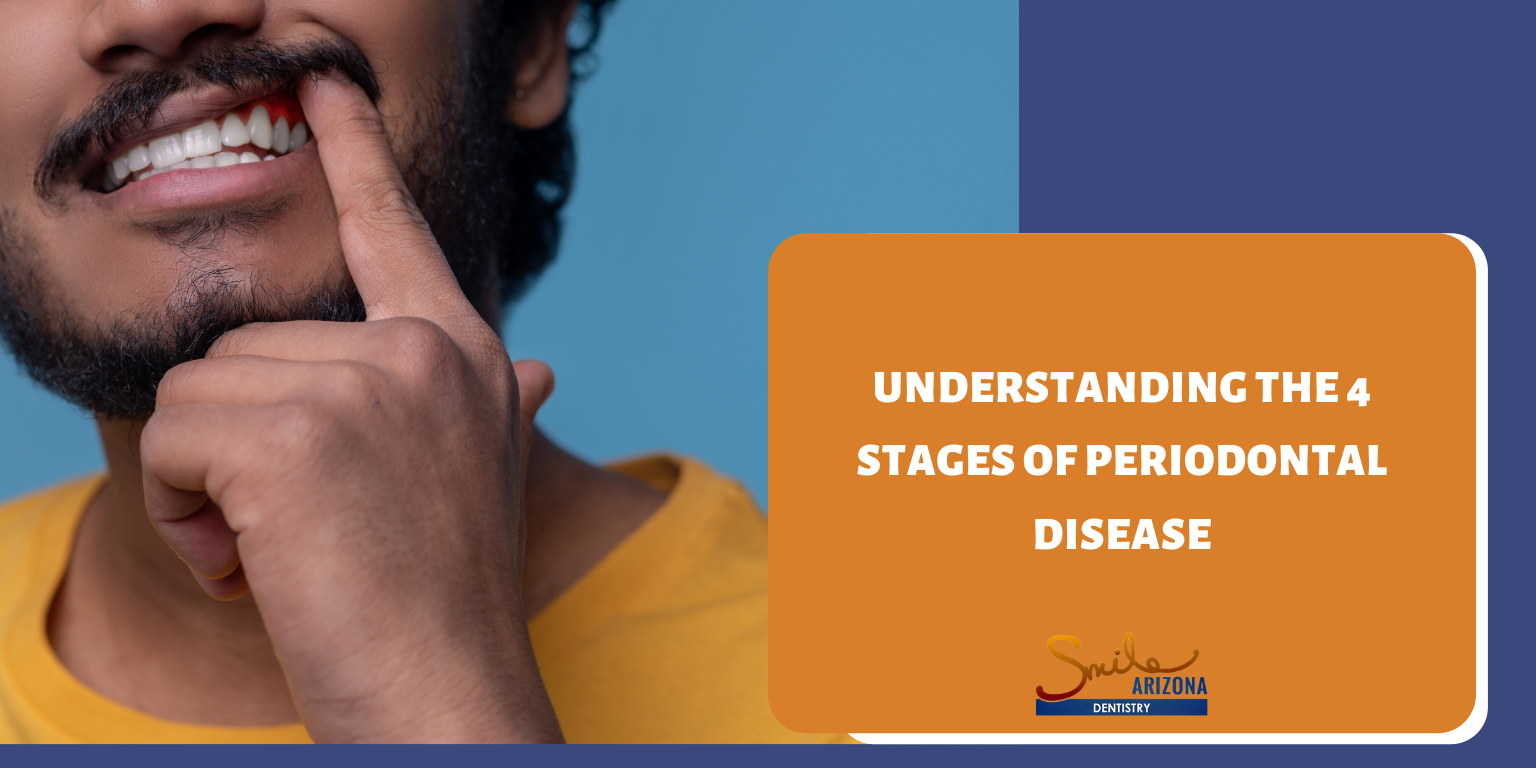 Understanding the 4 Stages of Periodontal Disease