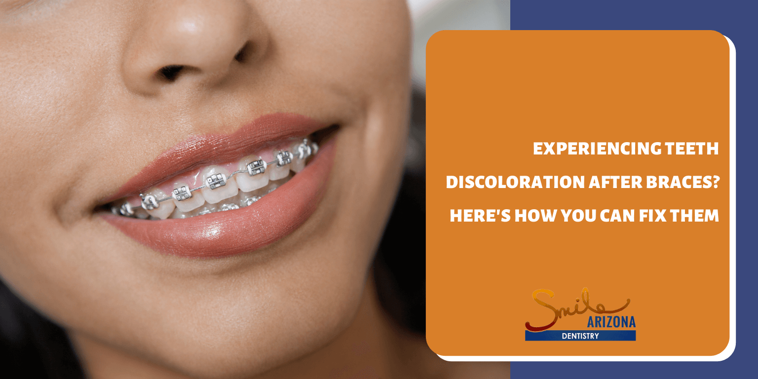Experiencing Teeth Discoloration After Braces? Here's How You Can Fix Them