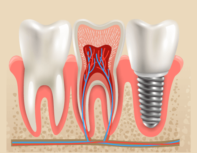 Dental Implants Scottsdale, AZ