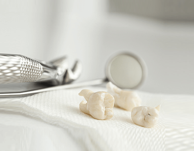 What Are the Common Cases for Tooth Extraction?