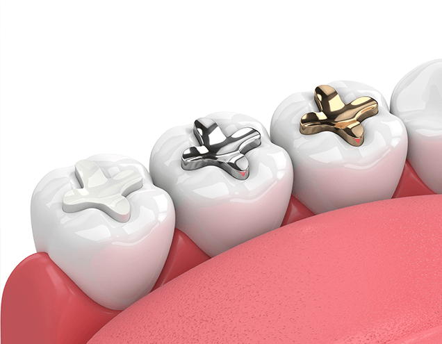 Other Types of Dental Fillings That We Offer