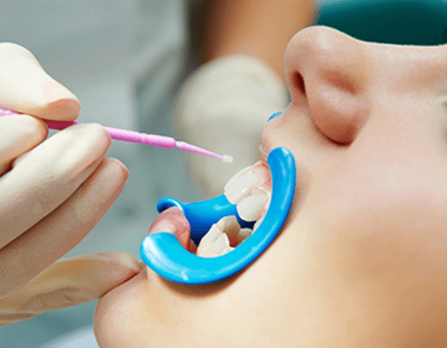 When Should You Get
                           Dental Sealants?